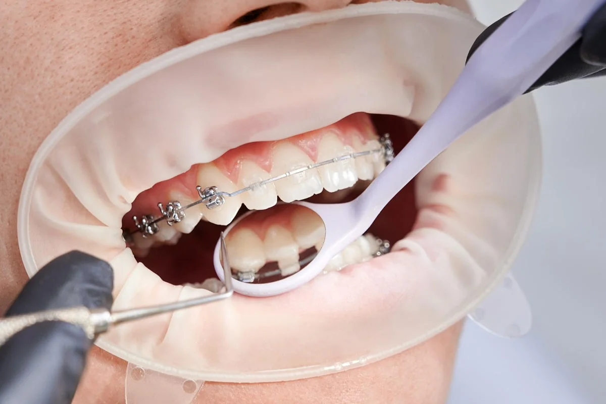 بیمه تکمیلی ارتودنسی و دندان